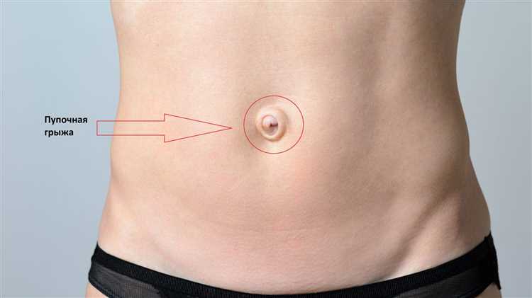 Грыжа у детей как распознать и лечить боли и дискомфорт