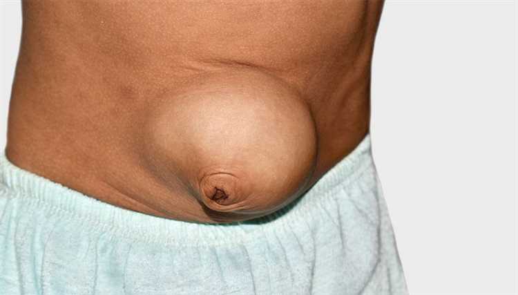 Грыжа у детей как распознать и что предпринять родителям