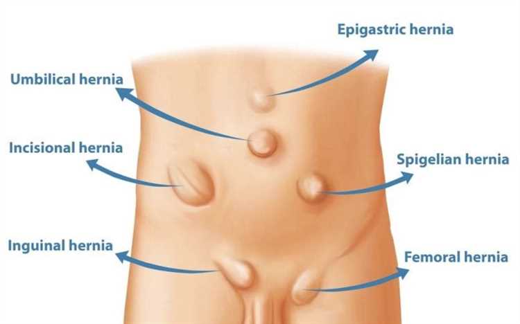 Грыжа у взрослых причины и профилактические меры