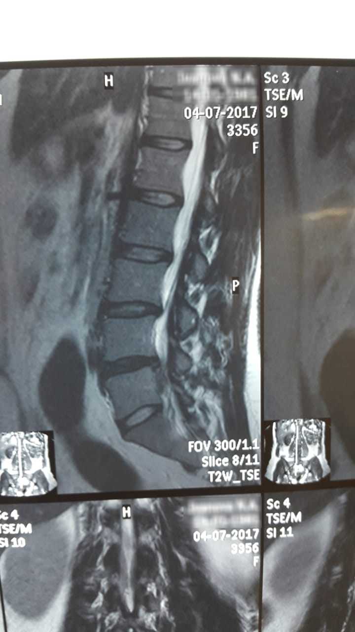 Истории победы над грыжей вдохновляющие примеры силы духа
