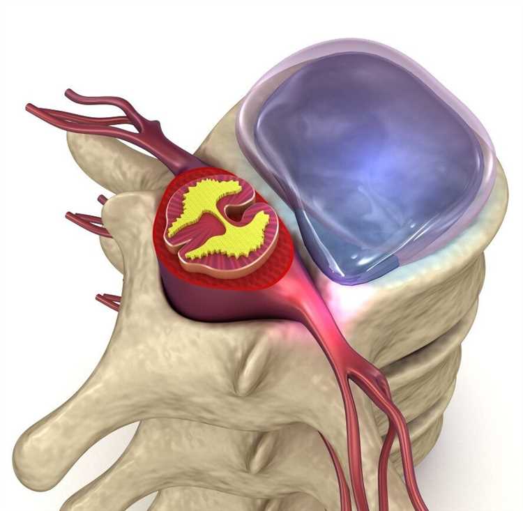 Как образ жизни влияет на развитие грыжи