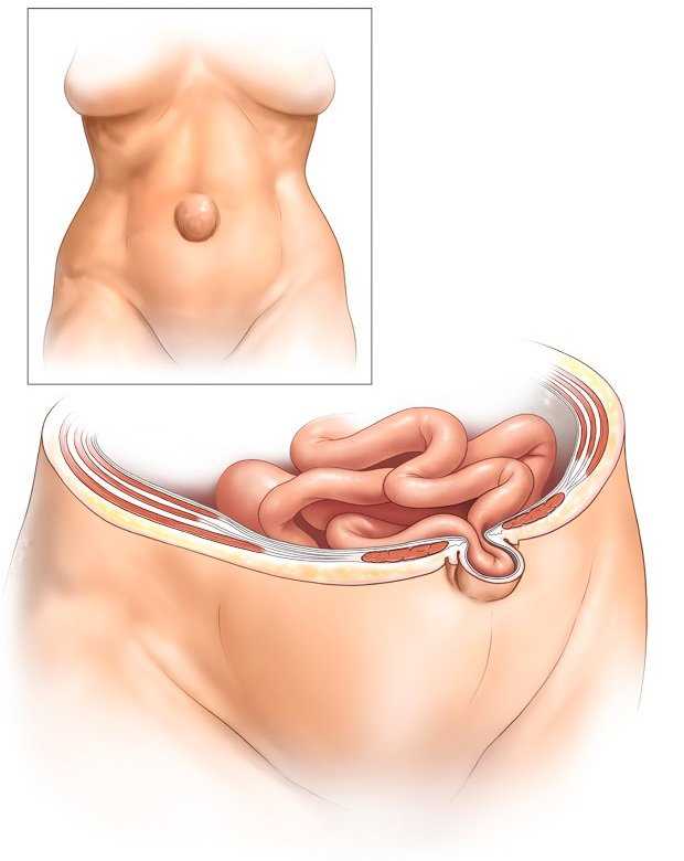 Грыжа живота причины симптомы и методы лечения