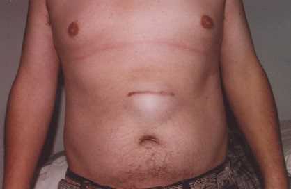 Грыжа живота основные симптомы диагностика и методы лечения