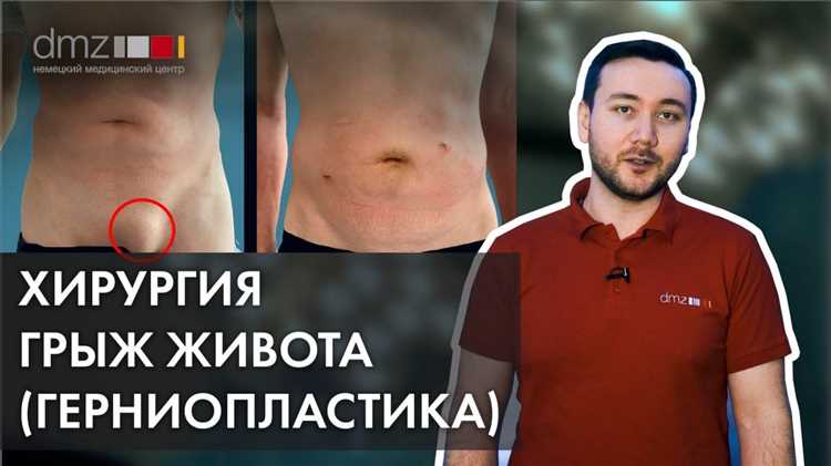 Эффективные методы лечения и восстановления при грыже живота