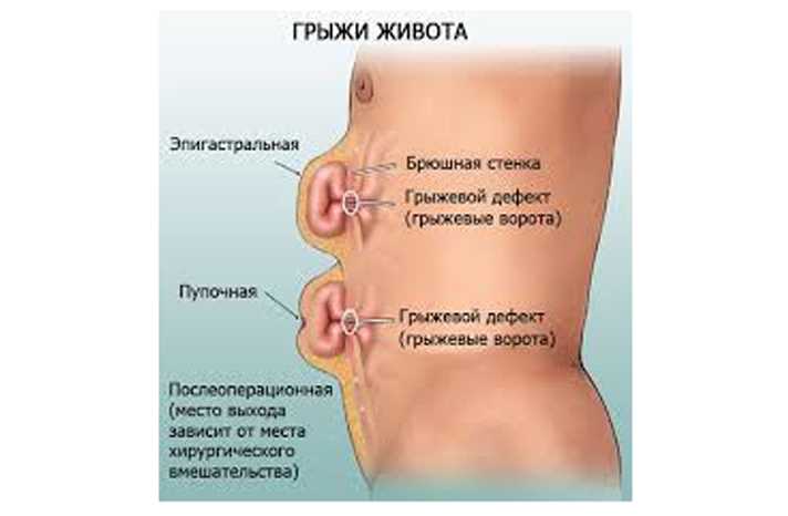 Грыжа Как Изменяется Жизнь После Лечения