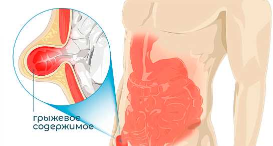 Эффективные методы лечения грыж советы специалистов
