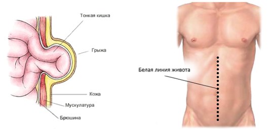 развитие грыжи