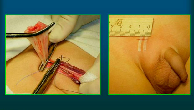 удаление паховой грыжи