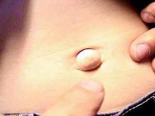 пупочная грыжа