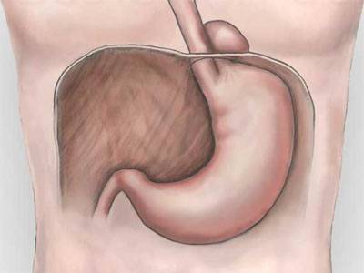 грыжа желудка