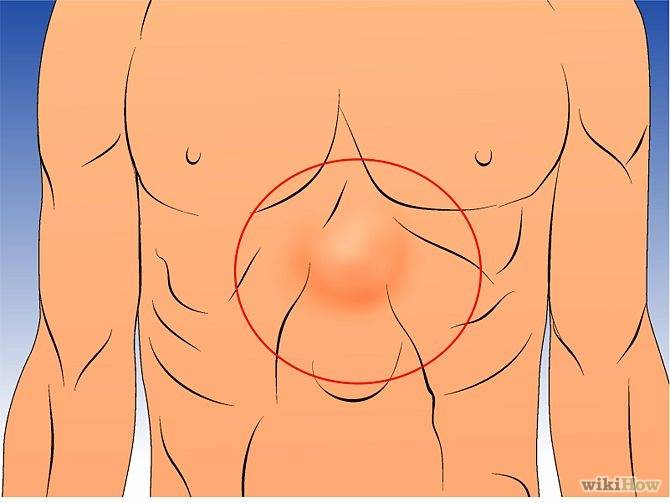 грыжа в области желудка