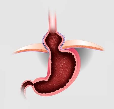 защемление