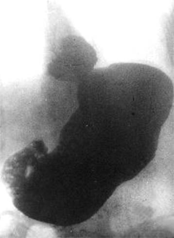 рентген при грыже