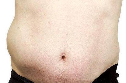 грыжа справа