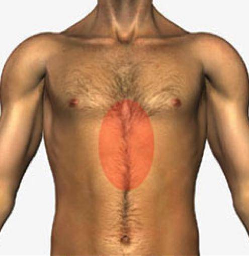 грыжа диафрагмы