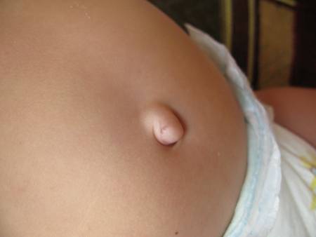 пупочная грыжа