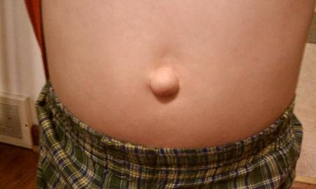 выпячивание пупка