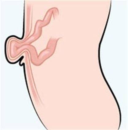 выход части кишечника