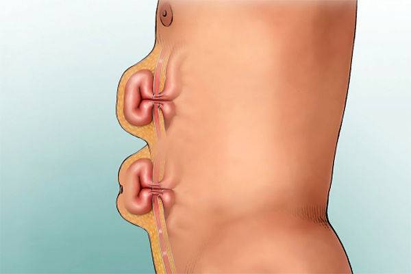 грыжа живота