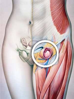 бедренная грыжа