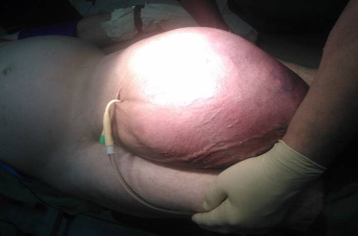 гигантская грыжа