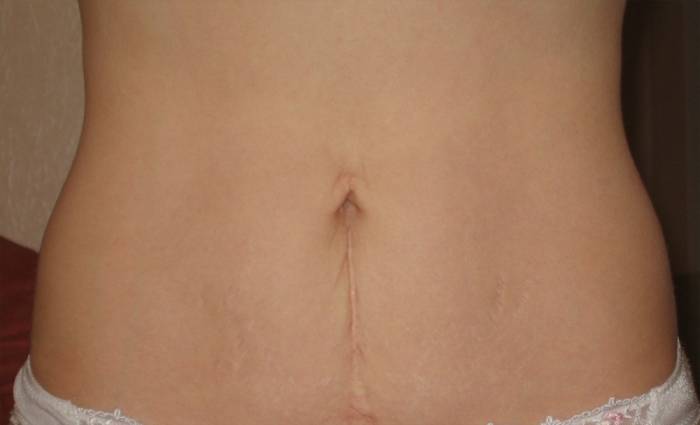 рубец на животе