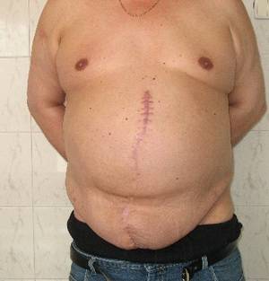 гигантская грыжа