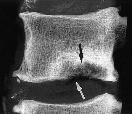грыжа шморля