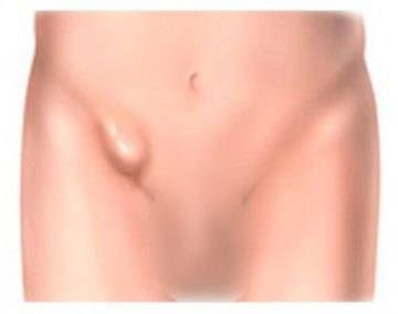 паховая грыжа