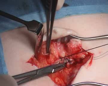 грыжесечение