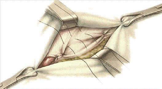 перевязка грыжевого мешка