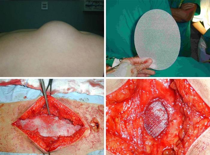 удаление грыжи белой линии живота