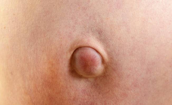 пупочная грыжа