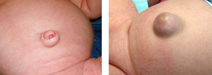 пупочная грыжа