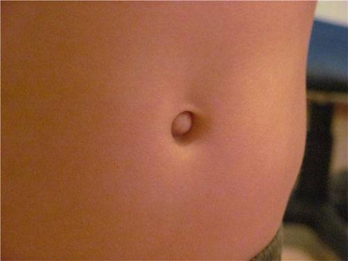 небольшая пупочная грыжа