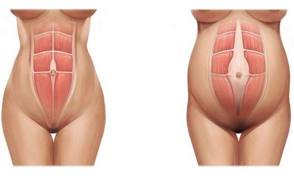 грыжа при беременности