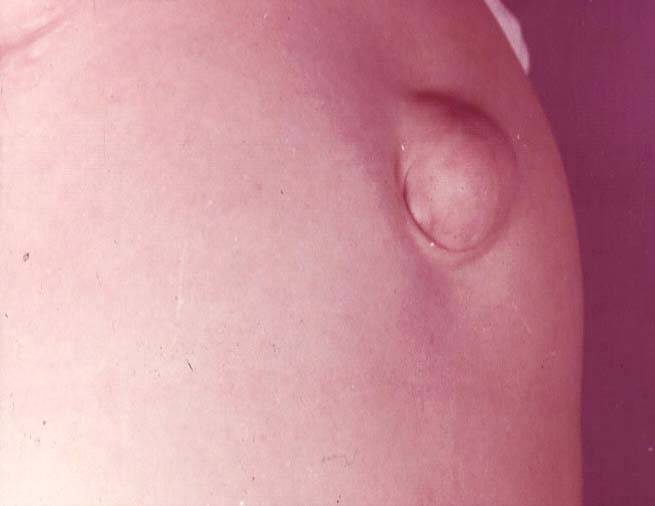 пупочная грыжа