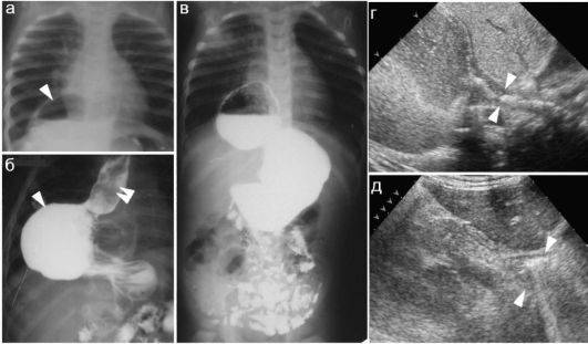 рентген грыжа пищевода