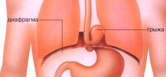 диафрагмальная грыжа