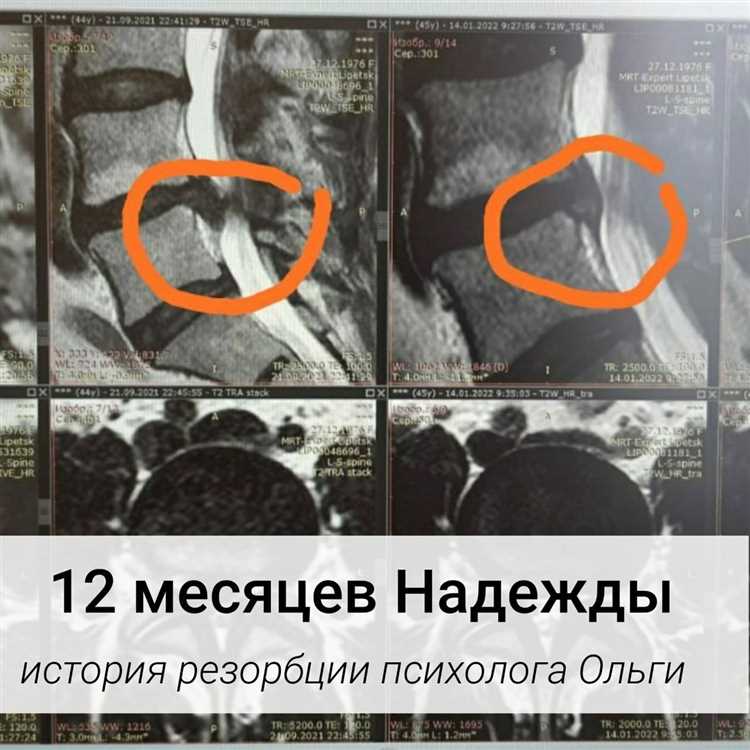 Победа над грыжей истории пациентов