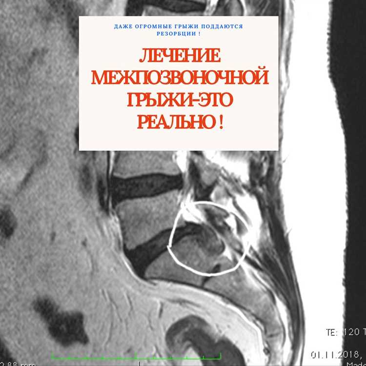 Победа над грыжей как путь к новой активной жизни