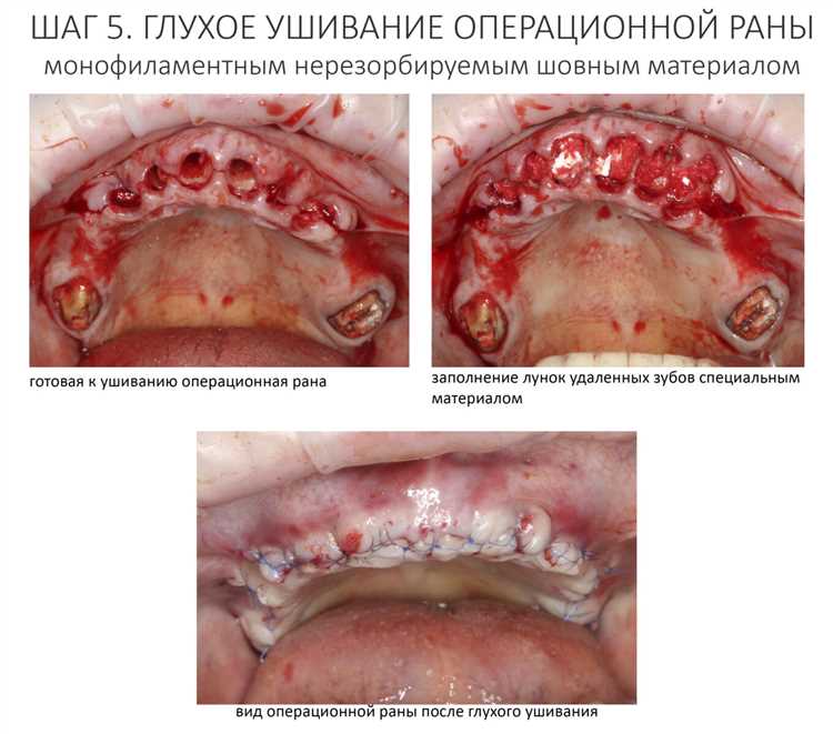 Неудачные истории пациентов после лечения грыжи и что делать дальше