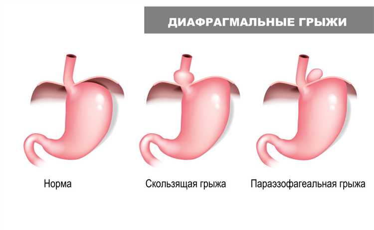 Диагностика грыжи и советы врачей