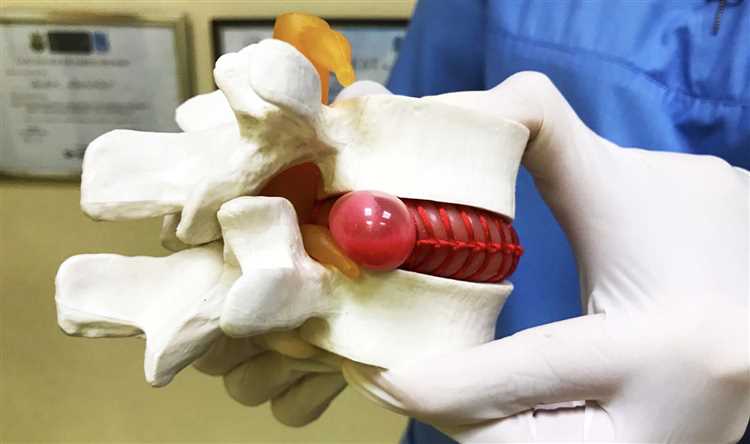 Влияние физической активности на течение заболевания грыжи