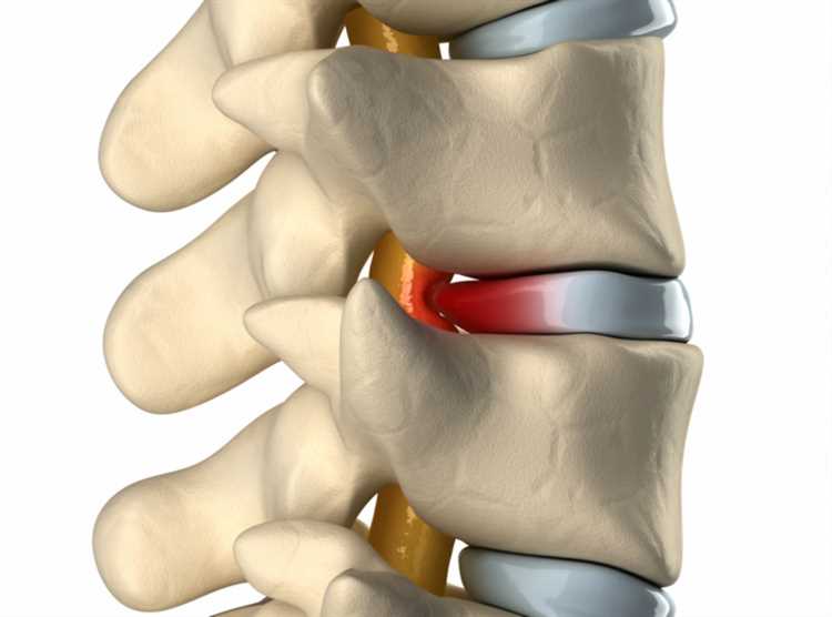 Влияние грыжи на качество жизни глазами пациентов