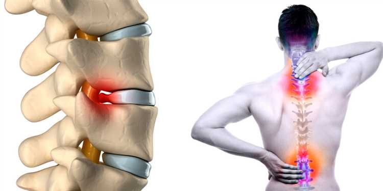 Эффективные методы лечения грыжи советы специалистов