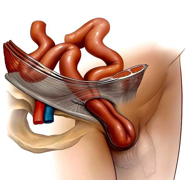 Влияние наследственности на лечение грыжи советы специалистов