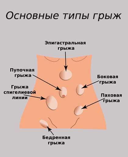Как определить грыжу и её симптомы по типам