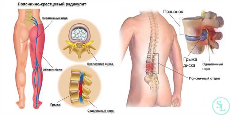 Эффективные меры профилактики развития грыжи
