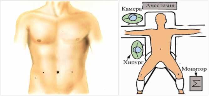 Пошаговое руководство по лапароскопической операции на грыжу